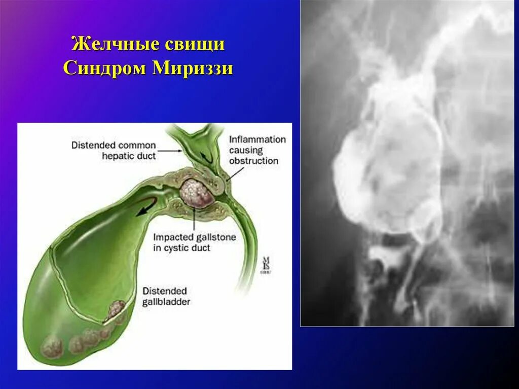 Сердце желчный пузырь