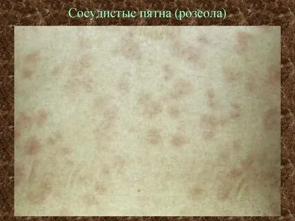Инфекция 6 букв