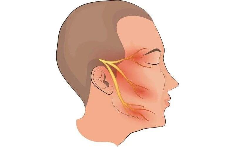 Повреждение тройничного. Невропатия тройничного нерва. Неврит нижнечелюстного нерва. Невриты и невралгии. Нейропатия тройничного нерва.