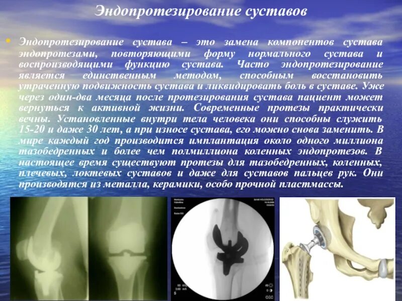 Эндопротезирование мкб 10 у взрослых. Эндопротезирование суставов. эндопротеза коленного сустава. компоненты эндопротеза коленного сустава. нестабильность эндопротеза коленного сустава.