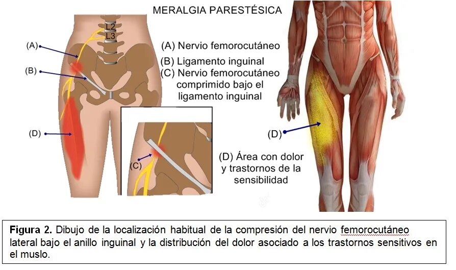 Парестетическая мералгия. Латеральный наружный кожный нерв бедра. Парастетическая миалгия. Парастетическая мералги я. Нейропатия бедра