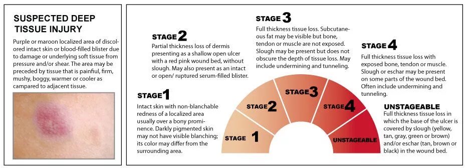 Stage 1 как выглядит. Stage 2. Stage 3. Что значит Stage.