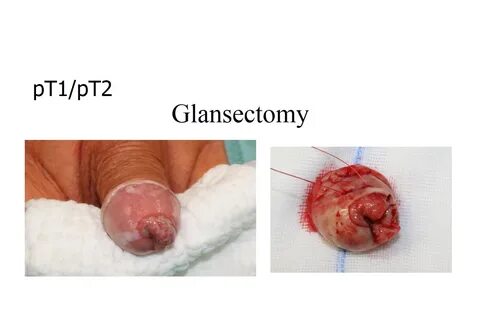 Glansectomy Pics 