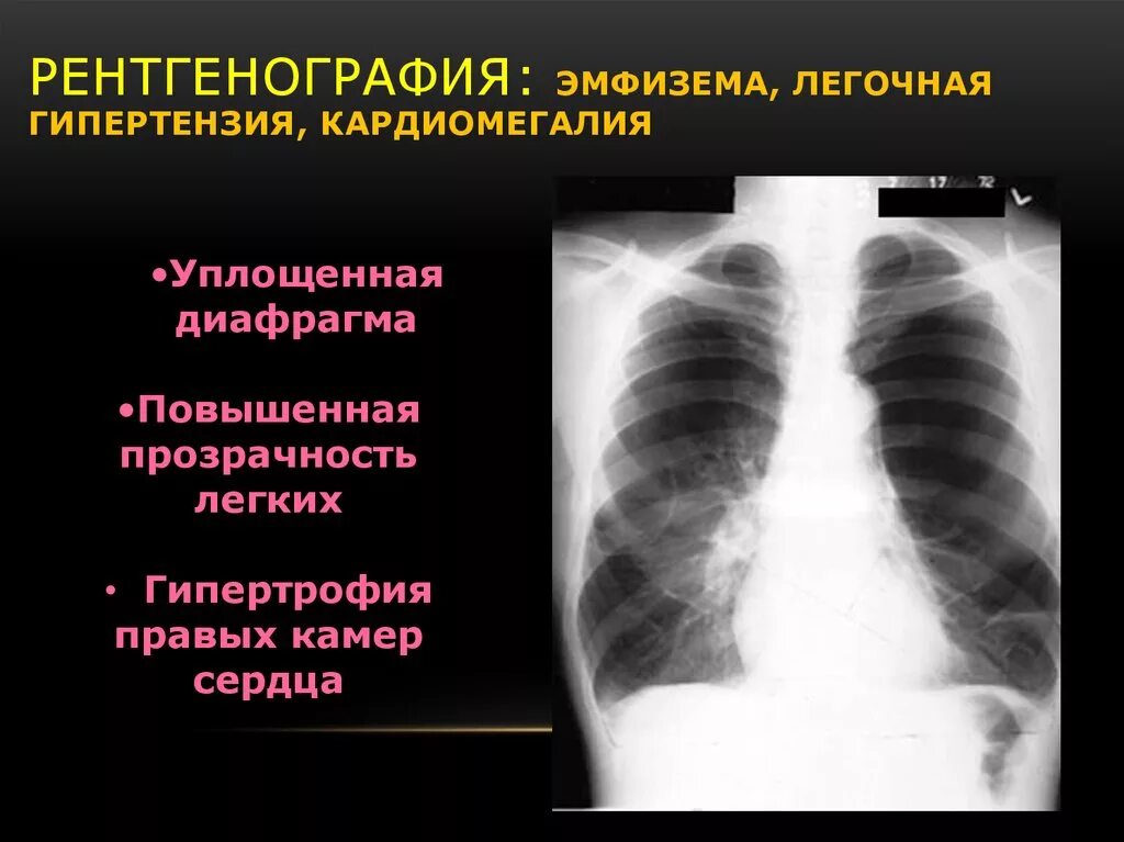 Хроническая эмфизема легких рентген. Буллезная эмфизема рентген. Буллезная эмфизема легких рентген. Легкие при эмфиземе на рентгене. Образование легких неуточненное