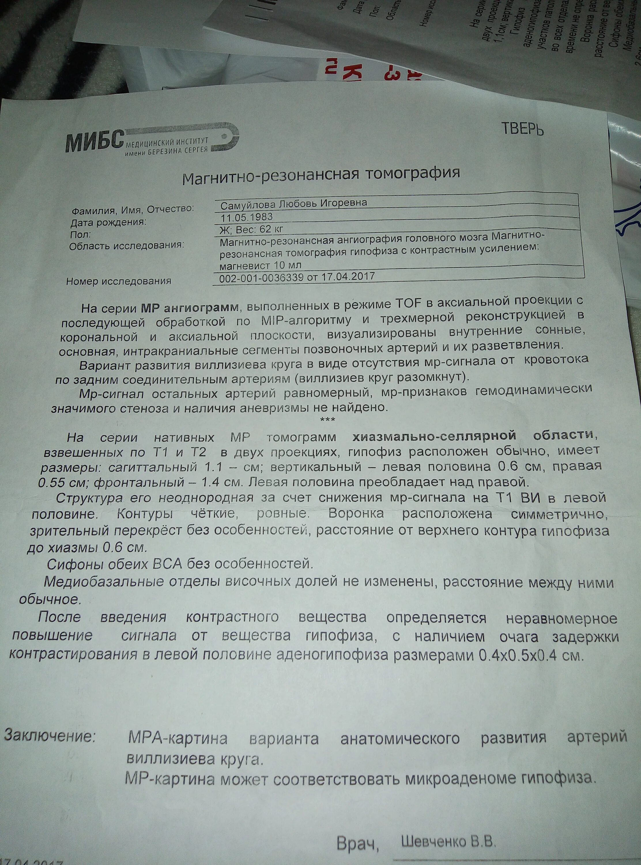 Развитие виллизиева круга в виде отсутствия кровотока. Виллизиев круг вариант развития. Отсутствие кровотока по обеим задним соединительным артериям.