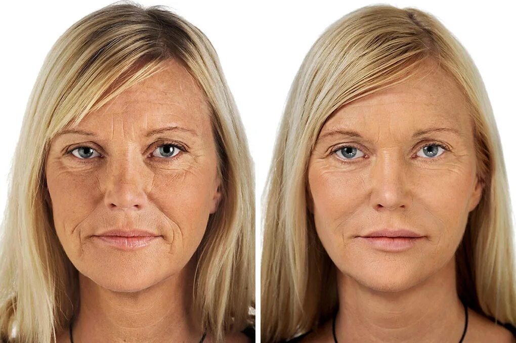 Инъекции после 30. Уколы красоты до и после. Ботокс для лица до и после. Женщина с морщинами. Морщины на лице.