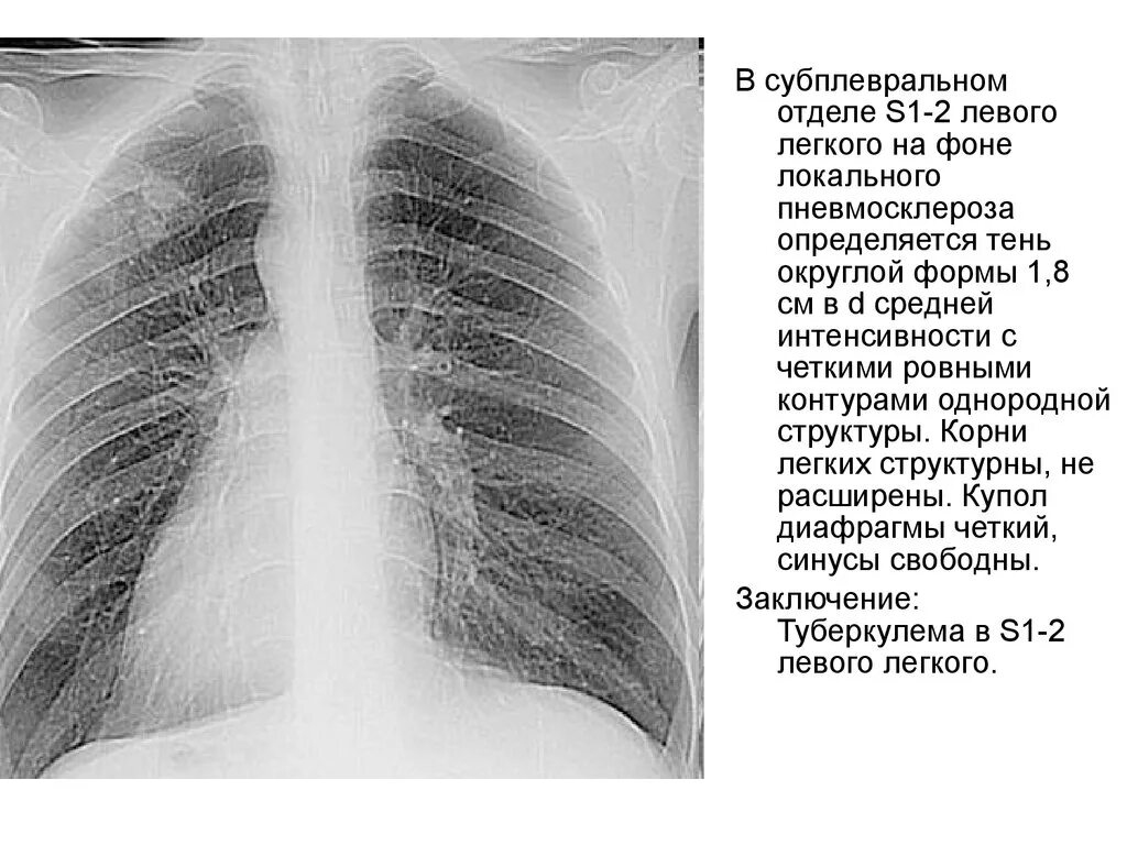 Очаг уплотнения s6 правого легкого. Туберкулема s1-2 левого легкого. Верхушки легких тени