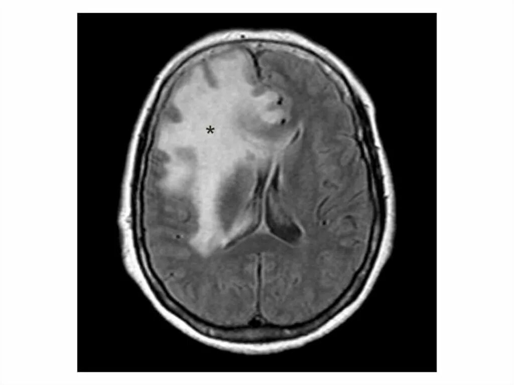 Перифокальный отек головного мозга мрт. Перифокальный отек головного мозга при опухоли мрт. Вазогенный отек головного мозга. Перифокальный отек вещества мозга что это. Отеков мозга головы
