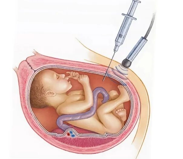 Прокол пузыря сколько схватки. Пункция околоплодной жидкости. Биопсия хориона амниоцентез кордоцентез. Солевой амниоцентез аборт.