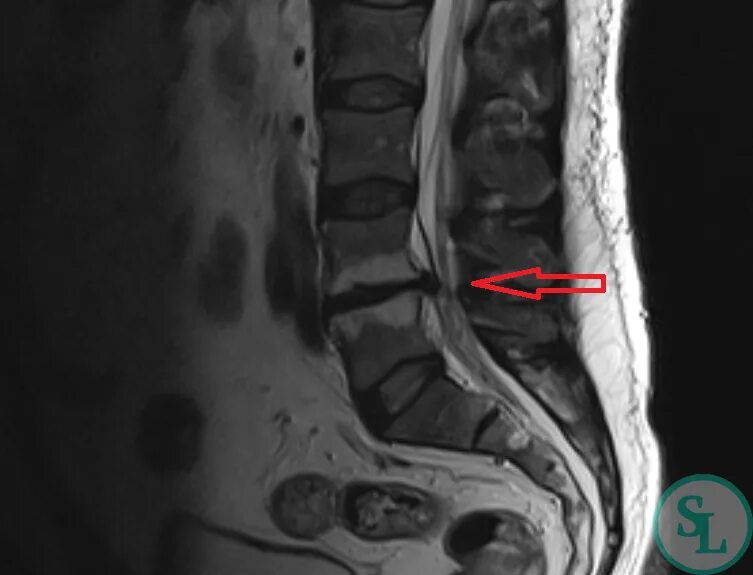 Протрузия диска на уровне l5 s1. Межпозвонковые диски l3-l4. Люмбокостальная грыжа. Грыжа диска l4-l5. Выбухание диска l4-l5.
