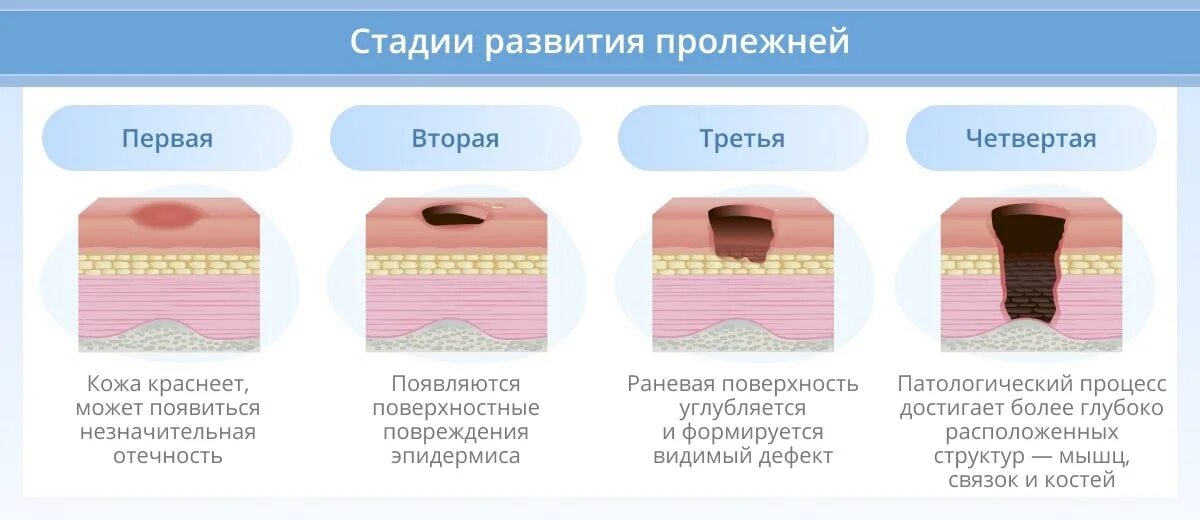 Через 1 стадии. Вторая стадия клинического проявления пролежней. Симптомы стадий пролежней. 4 Степени образований пролежней.