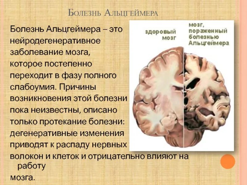 Атрофия головного мозга продолжительность. Болезнь Альцгеймера. Болезнь Альцгеймера головной мозг.