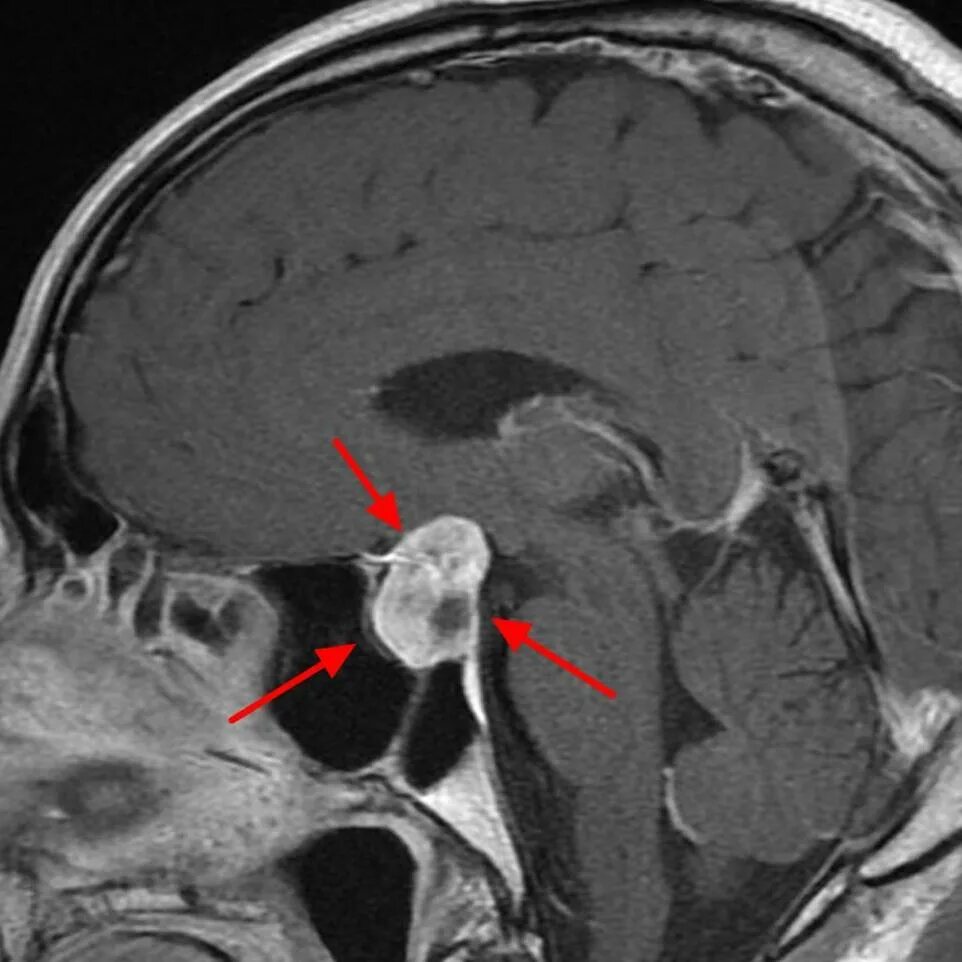 Опухоль гипофиза. Микроаденома гипофиза головного мозга мрт. Кистозная аденома гипофиза мрт. Гипофиз головного мозга на мрт патология.