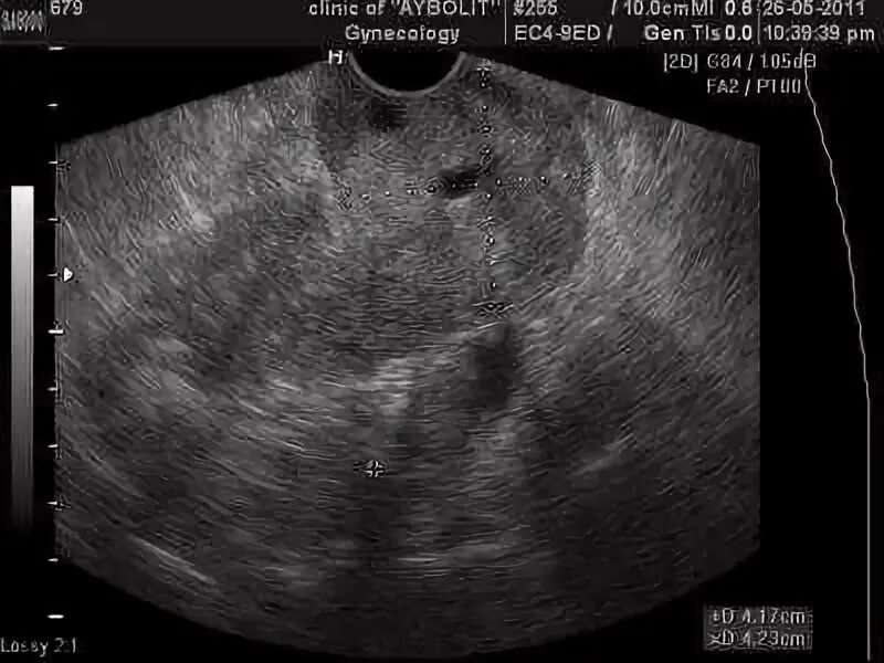 Myoma or pregnancy: how to distinguish