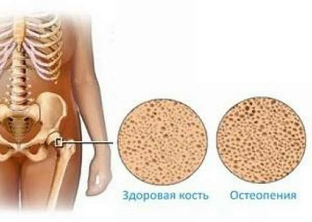 Остеопении