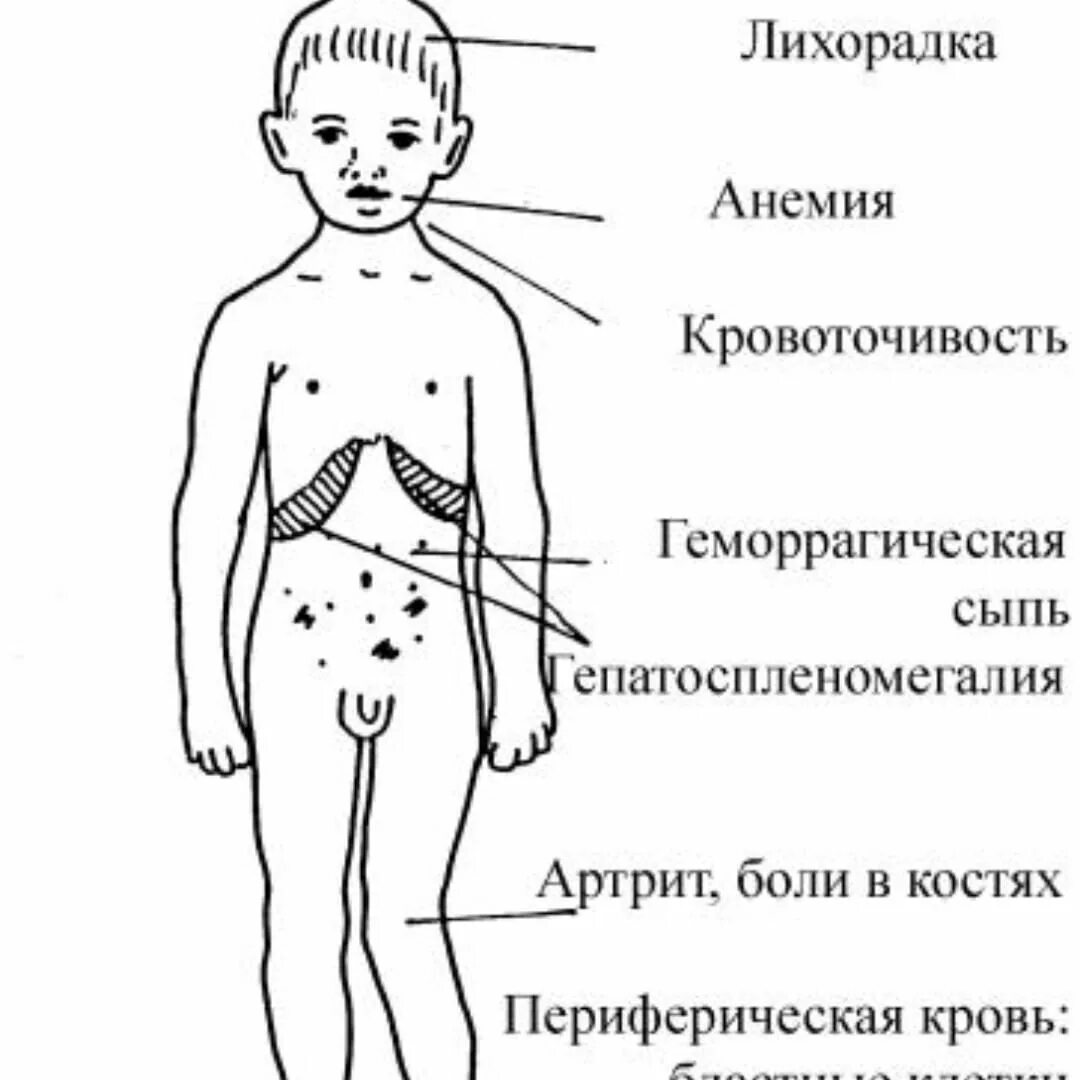 Лейкемия симптомы у детей