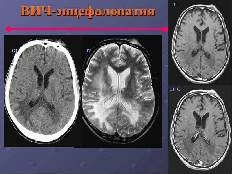 Вич ассоциированные заболевания. Вич ассоциированная энцефалопатия. Вич ассоциированная энцефалопатия. Мультифокальная лейкоэнцефалопатия гистология. Нейроспид клинические рекомендации.