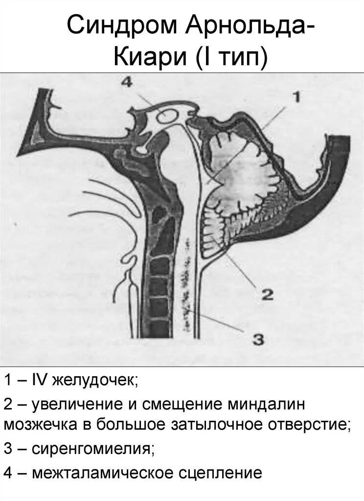 Аномалия Арнольда Киари типы. Мальформация Киари 1 и 2 типа. Синдром Арнольда-Киари 1 типа.