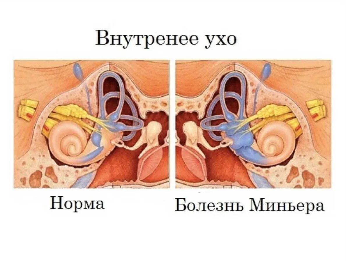 Внутреннее воспаление