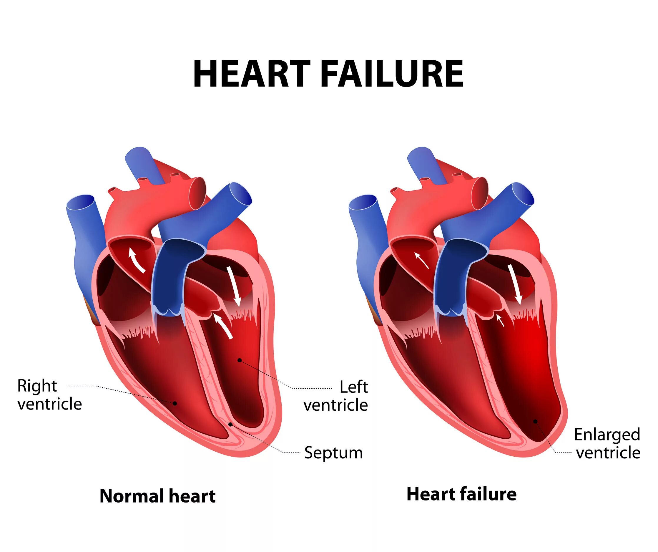 Сердечная недостаточность. Левый желудочек. Левый желудочек сердца. Здоровое и больное сердце.
