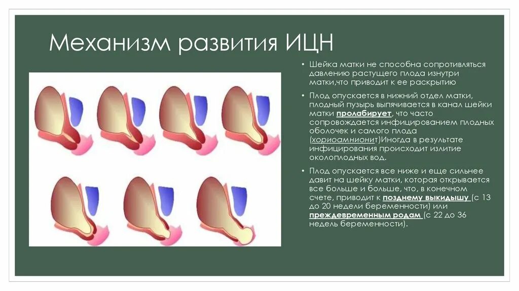 Истмико-цервикальная недостаточность — короткая шейка матки);. Исвихоцервикальнач недостаточность. Пролабирование плодного пузыря. Швы при ицн