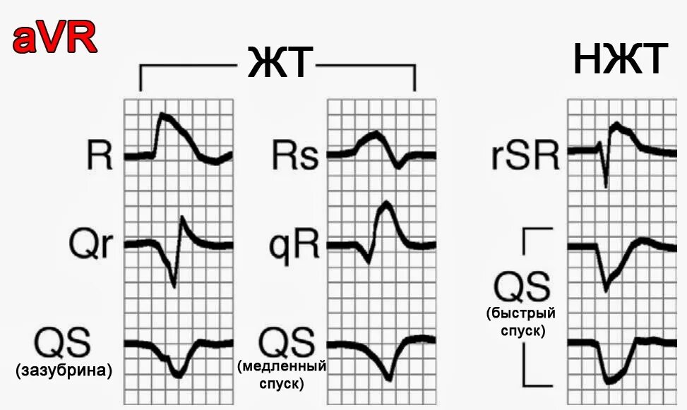 Отведение AVR на ЭКГ. AVR AVL AVF отведения на ЭКГ. Зубцы в отведении AVR. Зубец r в отведении AVR. Отведение v1 на экг