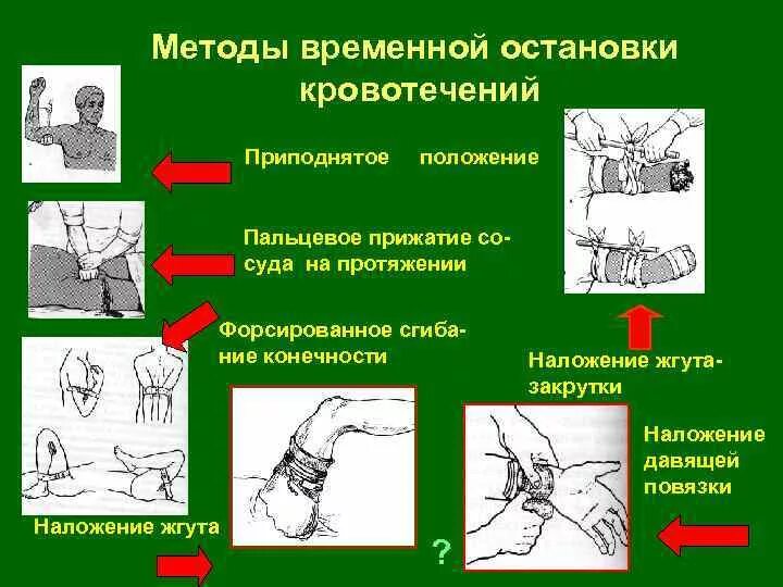 Способы временной остановки кровотечения наложение давящей повязки. Алгоритм временного остановки кровотечения. Способы остановки (временной остановки) наружного кровотечения. Способы временного гемостаза при артериальном кровотечении. Методы временной остановки венозного, артериального кровотечения.