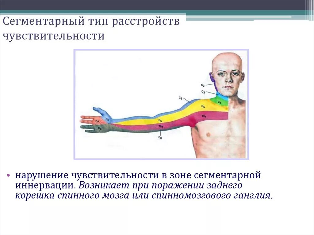 Периферический корешковый Тип. Сегментарное поражение чувствительности. Сегментарный Тип нарушения чувствительности неврология. Сегментарно-корешковый Тип расстройства.