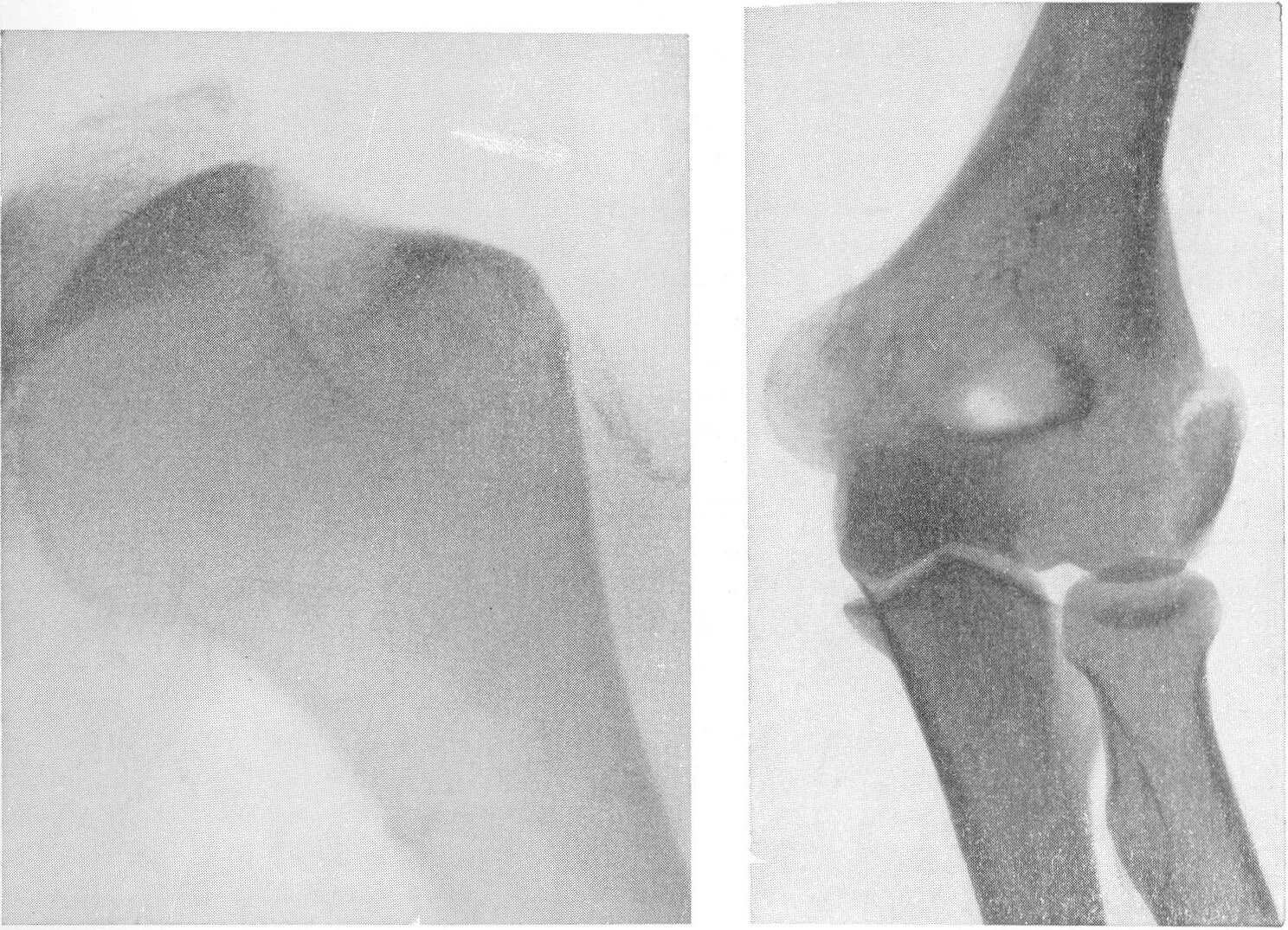 Мыщелки плеча. Межмыщелковый перелом плечевой кости рентген. Чрезмыщелковый перелом плечевой кости. Чрезмыщелковый перелом плеча рентген. Чрезмыщелковый перелом плечевой кости рентген.