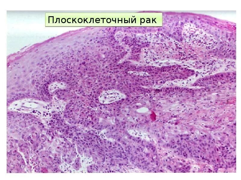 Онкология ротовой полости. Опухоли слизистой оболочки полости рта. Рак головки члена