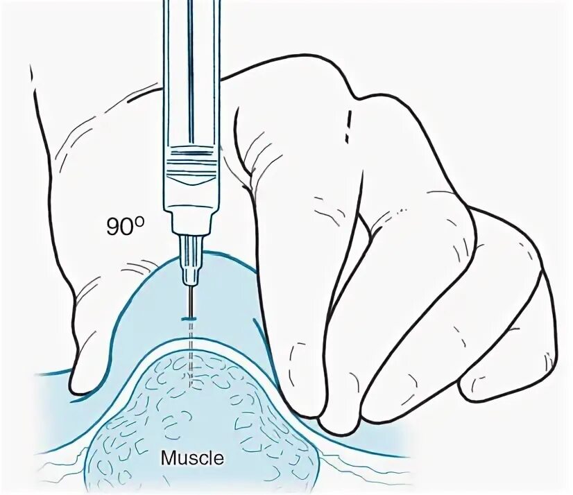 Как правильно колоть железо. Схема внутримышечных инъекций масляных растворов. Схема ВМ инъекций. Внутримышечная инъекция в бедро алгоритм. Схема внутримышечной инъекции в бедро.