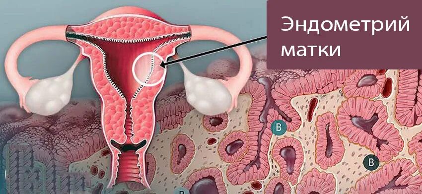 Увеличенная эндометрия матки. Гипопластичный эндометрий.