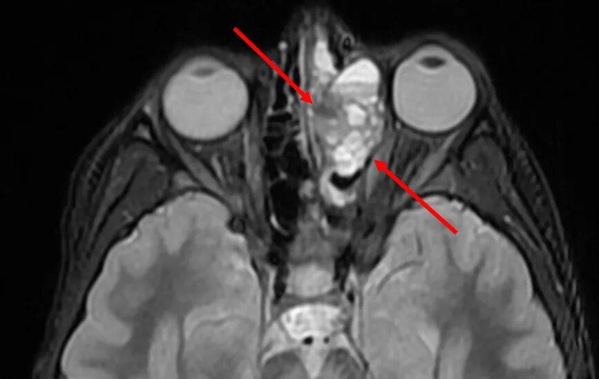 Опухоли клиновидной пазухи кт. Остеоид-остеома лобной пазухи мрт. Опухоли орбиты