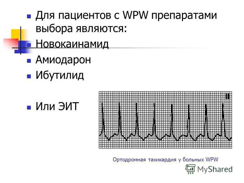 ортодромная атриовентрикулярная реципрокная тахикардия. синдром впв ортодромная тахикардия. ортодромная тахикардия. синдром впв ортодромная тахикардия. наджелудочковая тахикардия с wpw синдромом.