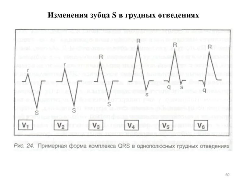 Нарастание зубца r. Зубец s и r в отведении грудных. Зубец s в грудных отведениях в норме. Зубцы в грудных отведениях. Нарастание зубца r в грудных отведениях.