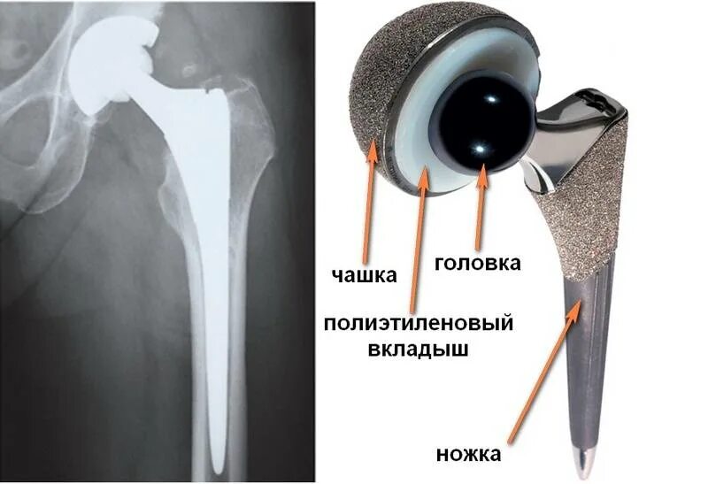 Эндопротез тазобедренного сустава DEPUY. Цементный эндопротез тазобедренного сустава. Цементная мантия эндопротеза тазобедренного сустава. Рентген эндопротеза тазобедренного сустава.