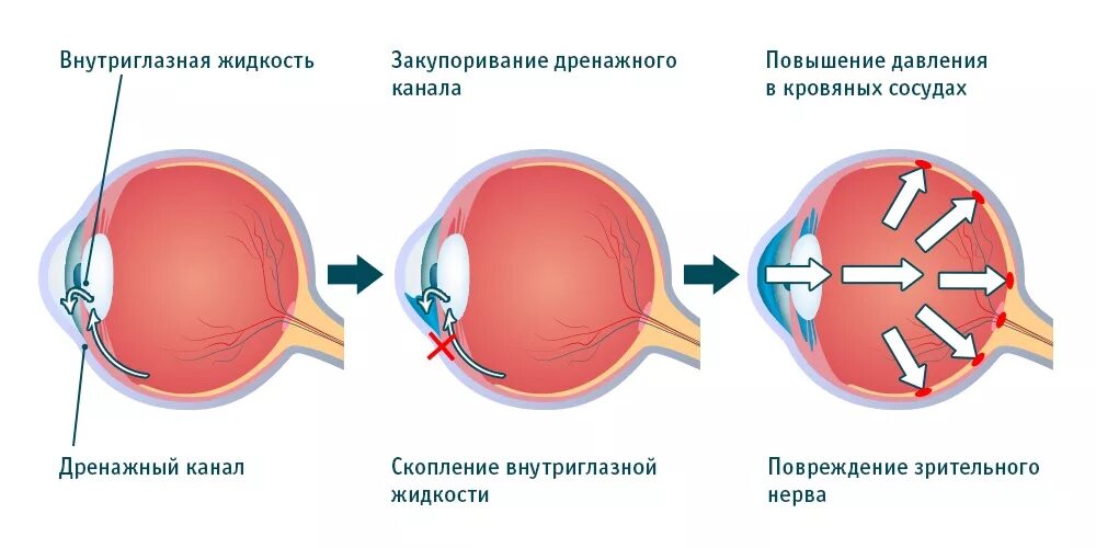 Внутриглазное давление в домашних условиях. Схема циркуляции внутриглазной жидкости. Глаукома схема глаза. Нарушение оттока внутриглазной жидкости. Схема циркуляции внутриглазной жидкости офтальмология.