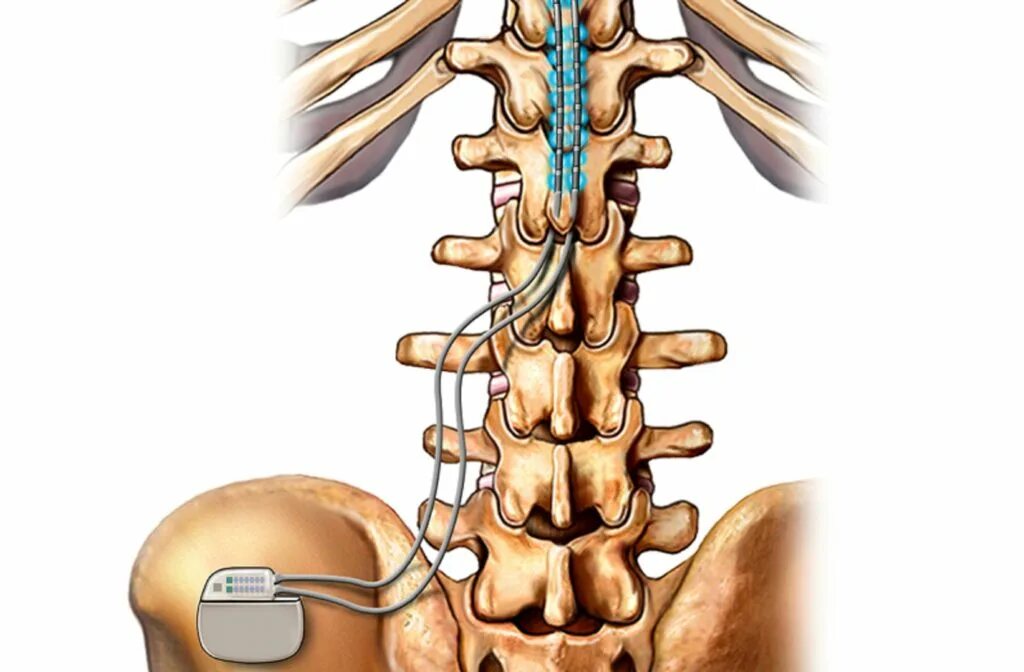 Спинальный стимулятор позвоночника. Спинной мозг. Spinal Cord stimulation. Стимуляция спинного мозга.