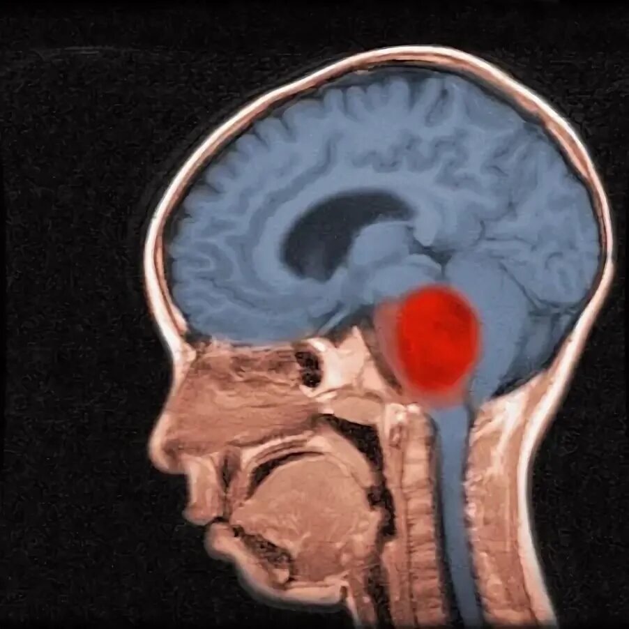 Рак ствола головного мозга. Диффузная глиома ствола головного мозга. Глиома ствола головного мозга у детей.
