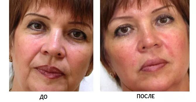 носогубки плазма лифтинг. до и после ботокса лица. лифтинг массаж до и после. ботокс для лица. ботокс до и после.