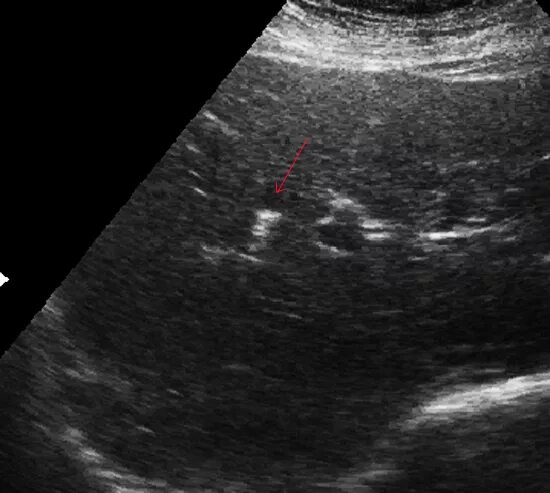 воздух в желчных протоках на кт. пневмобилия желчных протоков причины. пневмобилия желчных протоков узи. аэробилия. пневмобилия желчных протоков узи.
