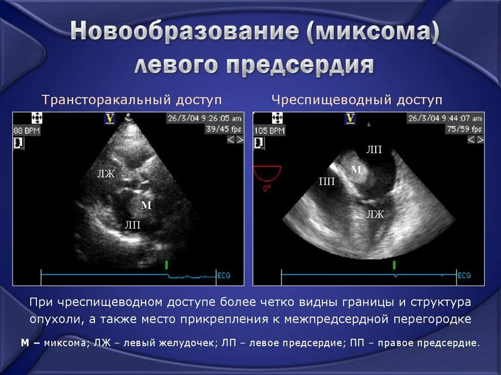 Образование левого предсердия. Дефект межпредсердной перегородки на ЭХОКГ. Аневризма межжелудочковой перегородки ЭХОКГ. Объемные образования сердца.