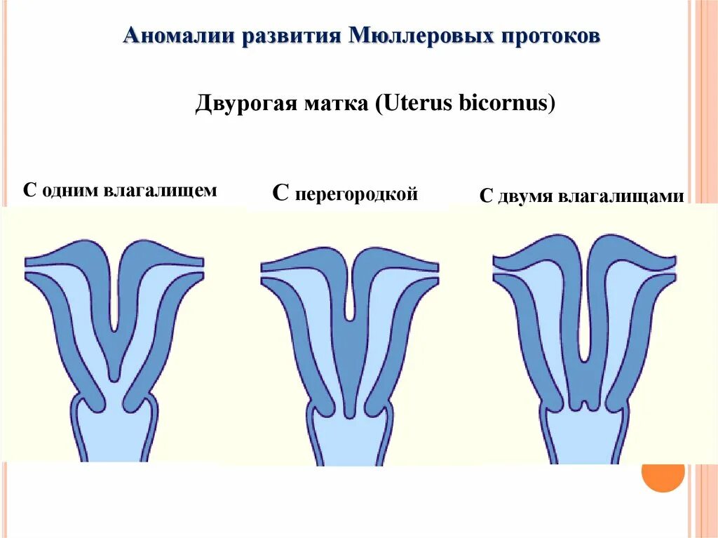 Аномалия матки двурогая. Аномалии развития мюллеровых протоков. Персистенция мюллеровых протоков.