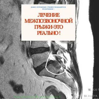 Резорбция грыжи что это