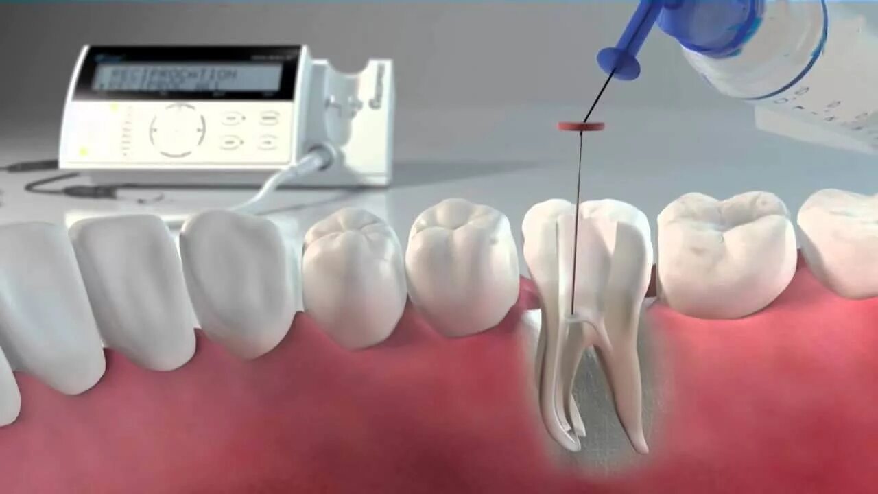 Расширение каналов зубов. Ультразвуковая ирригация корневых каналов. Временная пломбировка корневых каналов. Аппарат для пломбировки каналов зуба.