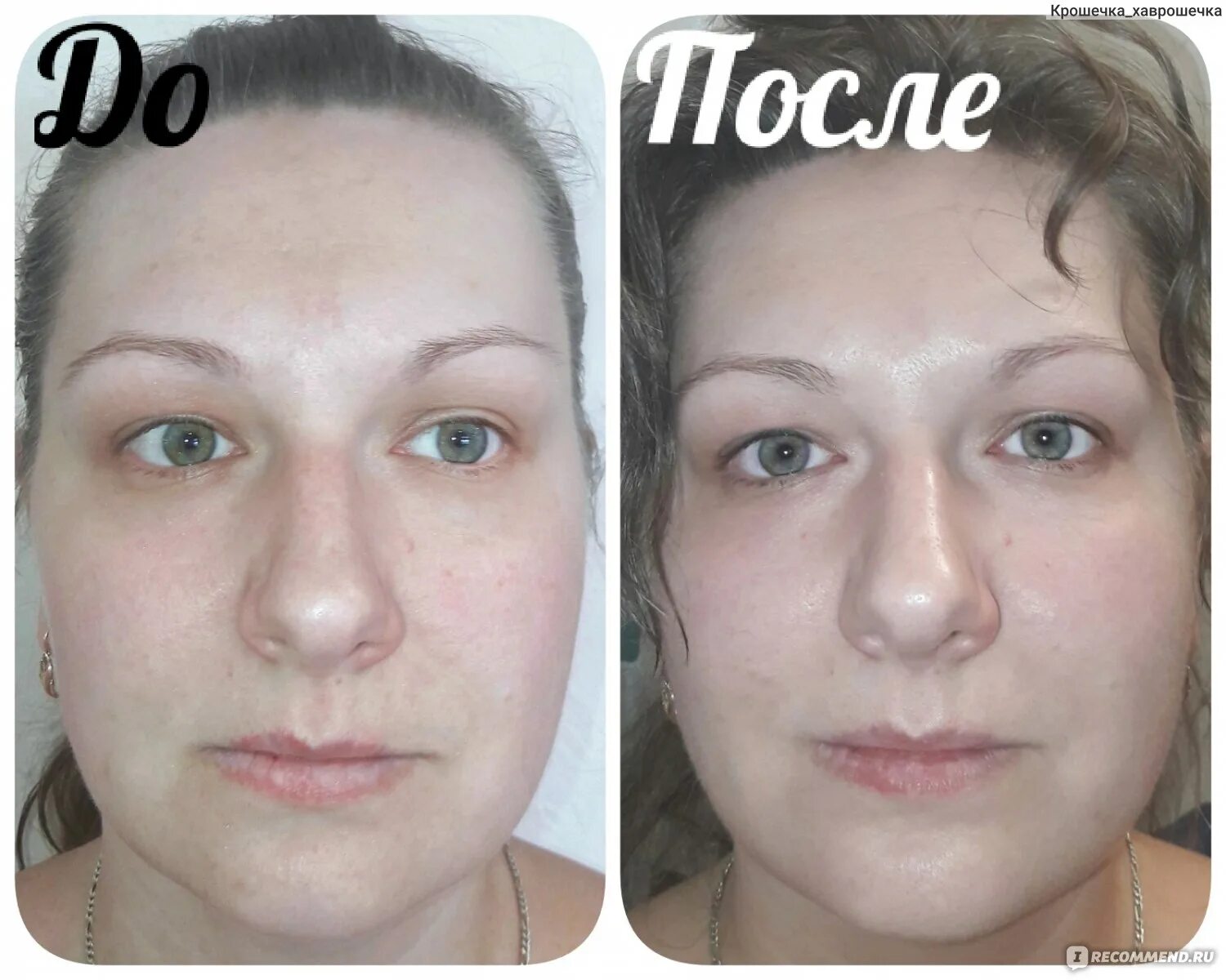 Молочный пилинг лица skinlift ru. Пилинг PH 3.5 молочная кислота для лица после. Пилинг для лица молочная кислота PH 3.5 до 10. Кислотный пилинг РН 3,5. Пилинг с молочной кислотой PH 3.5.