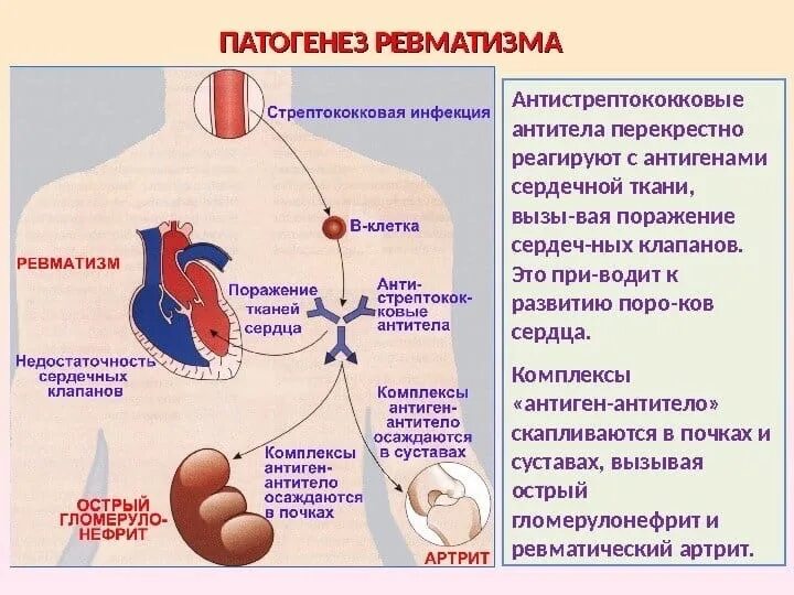Патогенез сердечных заболеваний. Патогенез поражения сердца при ревматизме. ревматическая болезнь сердца патогенез. ревматизм сердца этиология. ревматическая болезнь сердца этиология патогенез.