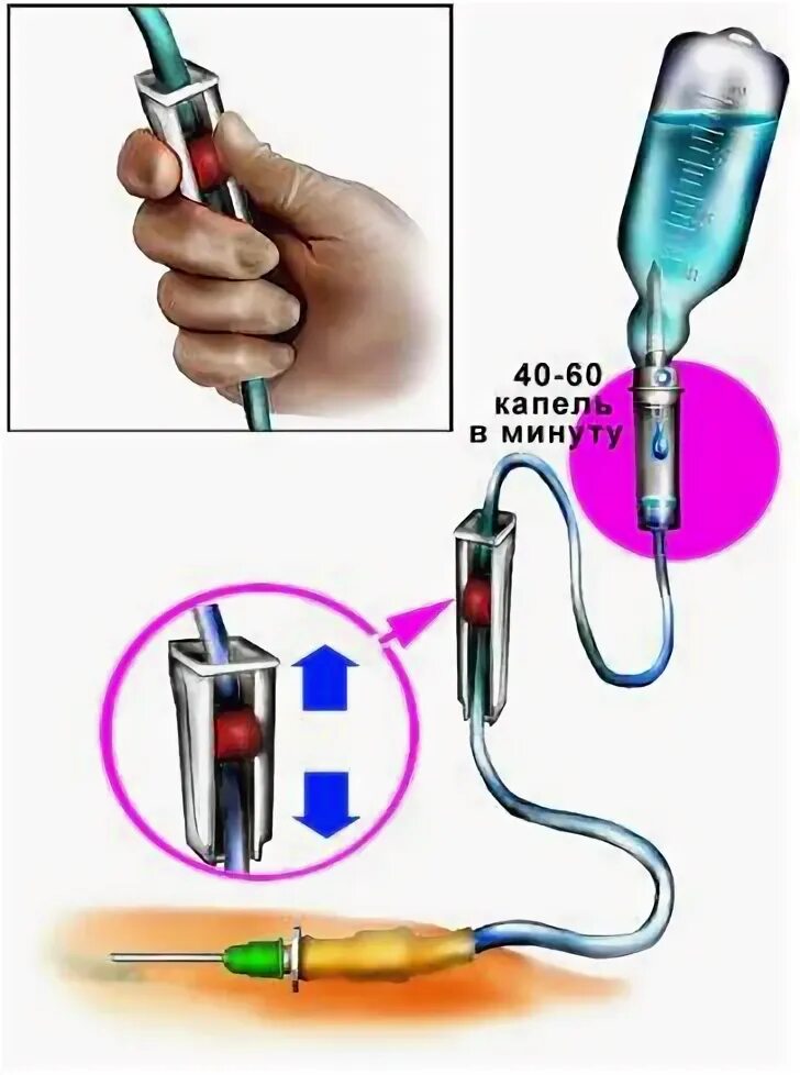 Заполнение внутривенной системы алгоритм. Система для внутривенного капельного вливания. Регулировка скорости капельницы. Регулировка капельницы медицинской. Система для внутривенного вливания винтовой зажим.