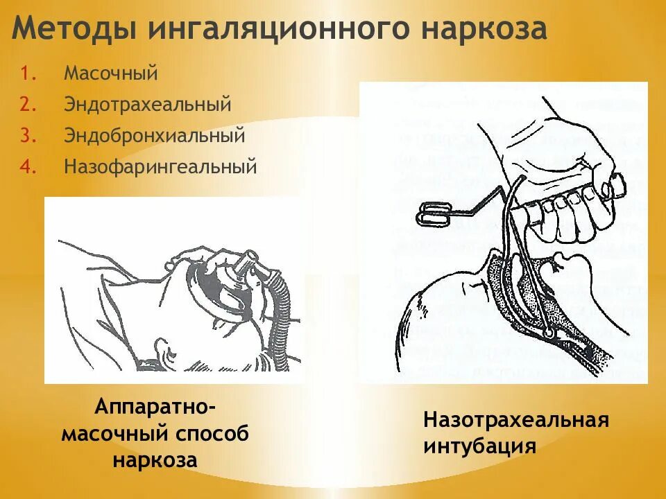 Ингаляционный наркоз. Ингаляционный наркоз эндотрахеальный. Методика эндотрахеального наркоза. Методика ингаляционной анестезии.