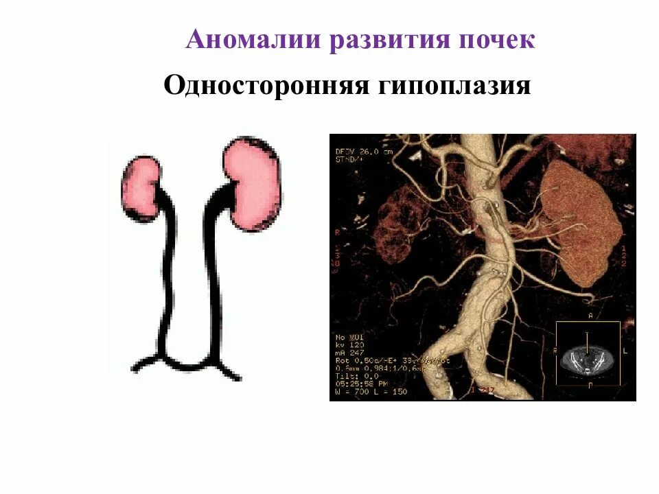 Аномалии развития мочеполовой. Пороки развития почек анатомия. Врожденные аномалии развития почек. Гипоплазия почечной артерии. Аномалии почек гипоплазия.